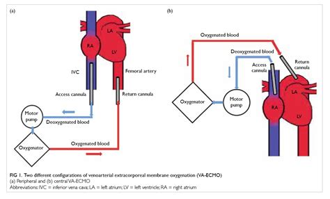 venting cannula for venoarterial ecmo